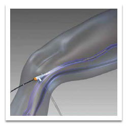 Diagram of a knee procedure.